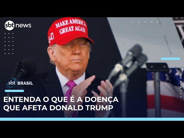 Insuficiência venosa crônica: médico explica o tratamento da doença de Donald Trump | #SBTBrasil 
