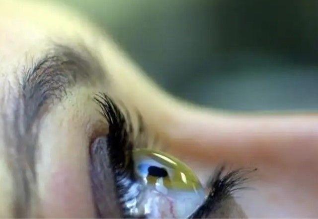 Você tem caso de glaucoma na família? Fique atento aos sinais