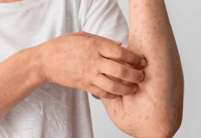 Rio Branco registra caso suspeito de Mpox; Brasil tem 46 casos confirmados