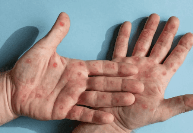 Mpox: quais são os sintomas e os principais grupos de risco para doença?