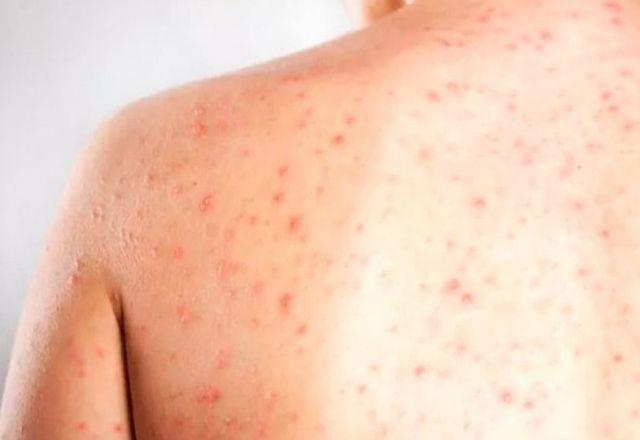 Cidade de SP confirma segundo caso importado de sarampo