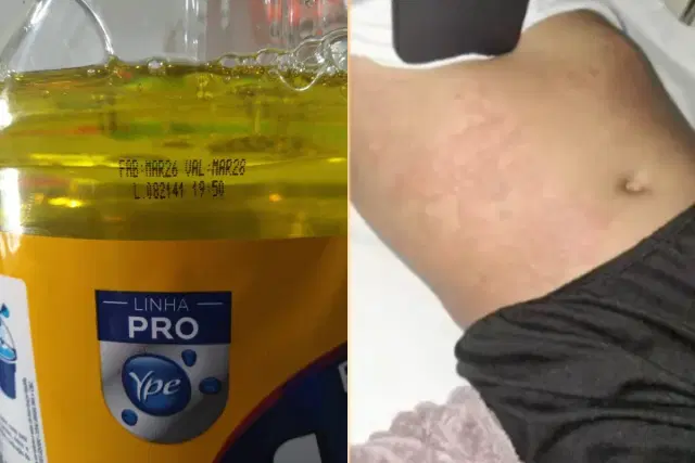 Lote contaminado da Ypê: menina é internada no RN com suspeita de intoxicação após uso de detergente