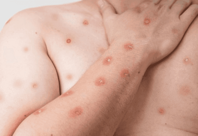 Mpox no Brasil: entenda o que é a doença e se há risco de novo surto